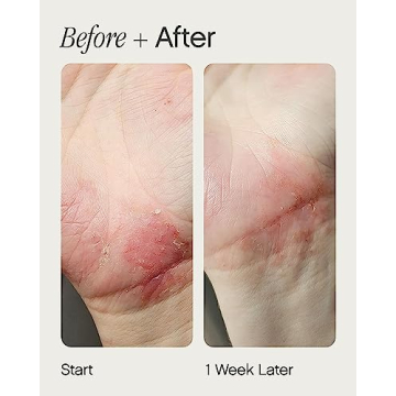 Topicals Like Butter Moisturizer for Eczema Relief and Hydration