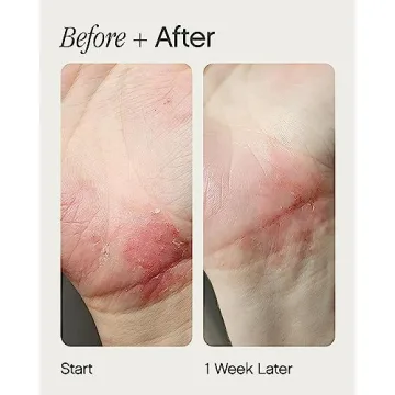 Topicals Like Butter Moisturizer for Eczema Relief and Hydration