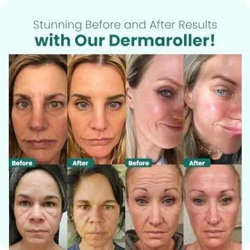 Gin Amber Derma roller (0.25mm) - 192 Real Individual Needles, Microdermabrasion Device for Skin Care, Serum Absorption with Microneedling, Safe and Painless Revitalizer Tool, Hygienic Case