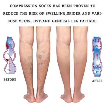 Lin Performance 15-20 mmHg Medical Compression Stockings for Women and Men Thigh High Dot-Top Open Toe Socks for Varicose Vein Swollen legs Travel Flight Pregnant(Beige,S)