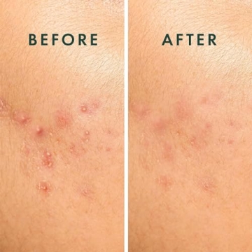 Rael Pimple Patches Hydrocolloid Acne Treatment 10 Count