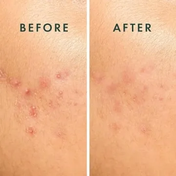 Rael Pimple Patches Hydrocolloid Acne Treatment 10 Count