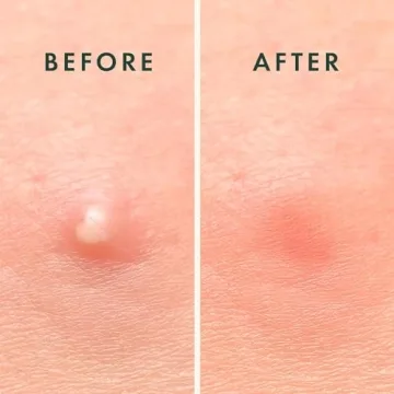 Rael Pimple Patches for Effective Overnight Blemish Treatment