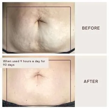 Pregnancy Stretch Mark Prevention with Dermaclara Patch