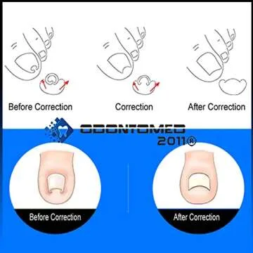 OdontoMed2011 Ingrown Toenail Corrector for Pain Relief