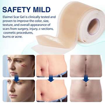 Silicone Scar Sheets (1.6”x 130”, 3.3M), Professional Silicone Scar Tape, Silicone Scar Strips, ...