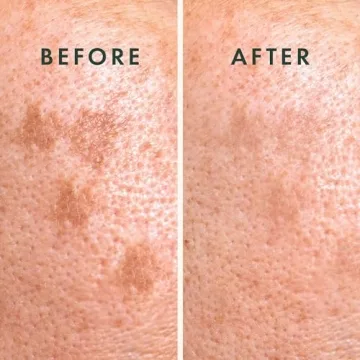 Rael Pimple Patches for Post Acne Treatment and Care