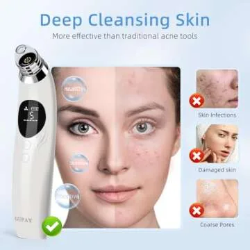 Blackhead Remover Vacuum with HD Camera and 5 Speeds