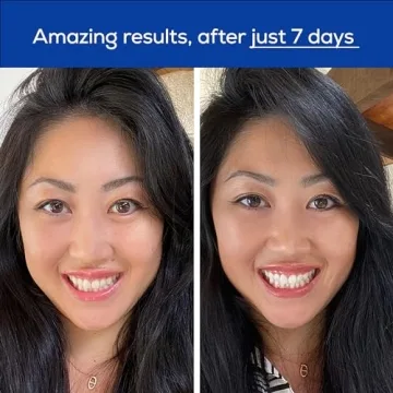 GLO Science Teeth Whitening Device for Sensitive Teeth