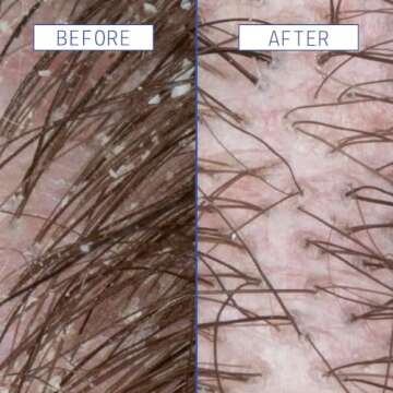 AAVRANI Scalp Rescue Serum - Vegan Salicylic Acid Treatment for Dandruff & Scalp Build Up - 2 Fl Oz