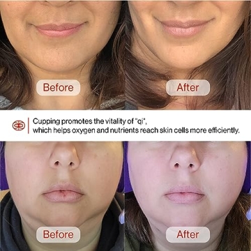 Rena Chris Facial Cupping Set for Skin Rejuvenation and Care