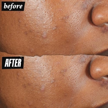 Kiehl's Acne-Clearing Pimple Patch: Fast Relief