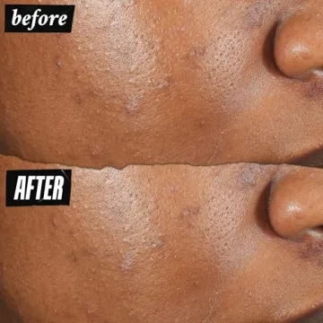 Kiehl's Acne-Clearing Pimple Patch: Fast Relief