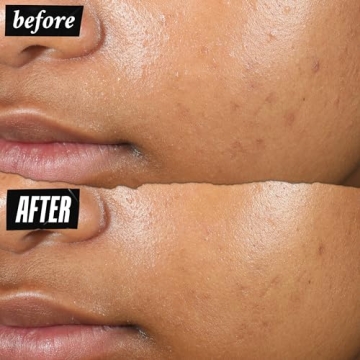 Kiehl's Acne-Clearing Pimple Patch: Fast Relief