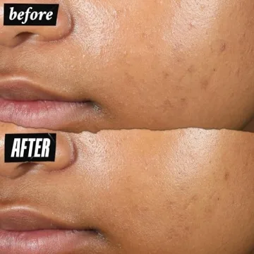 Kiehl's Acne-Clearing Pimple Patch: Fast Relief