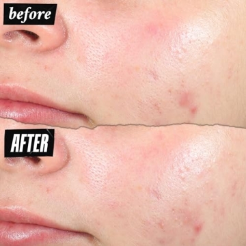 Kiehl's Acne-Clearing Pimple Patch: Fast Relief