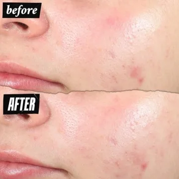 Kiehl's Acne-Clearing Pimple Patch: Fast Relief