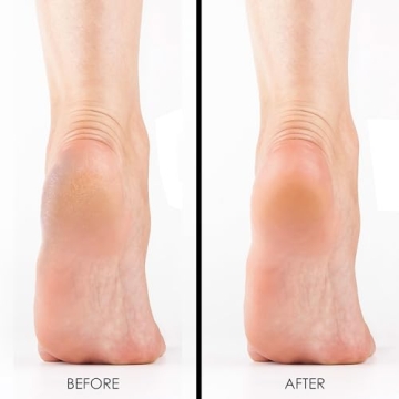 DeEnti Extra Strength Callus Remover Gel for Smooth Feet