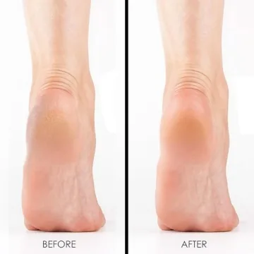 DeEnti Extra Strength Callus Remover Gel for Smooth Feet