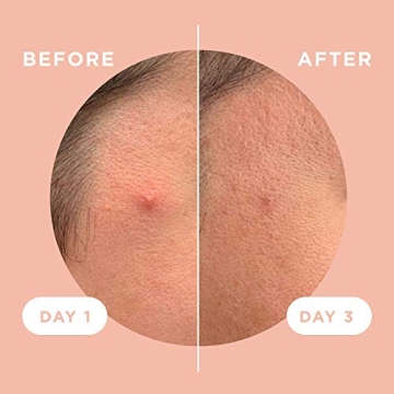 ZitSticka Killa Pimple Patches Fast-Acting Microdarts Deep Zits