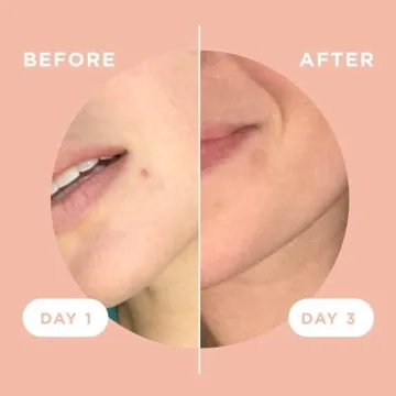 ZitSticka Killa Pimple Patches Fast-Acting Microdarts Deep Zits