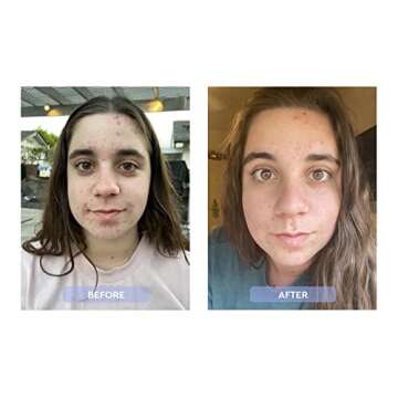 Dr. Zenovia Clear Complexion Acne Kit - Hormonal Acne Treatment - Benzoyl Peroxide Skin Care Kit - Acne Treatment Face Wash and Spot - Adult and Teen Acne