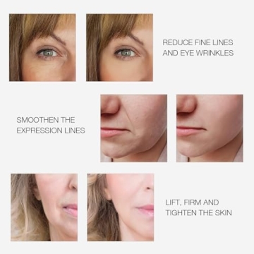 MLAY Radio Frequency Skin Tightening Device for Youthful Skin