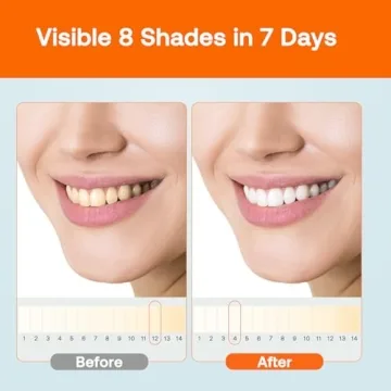 Bitvae LED Teeth Whitening Kit Safe Fast Sensitive Teeth