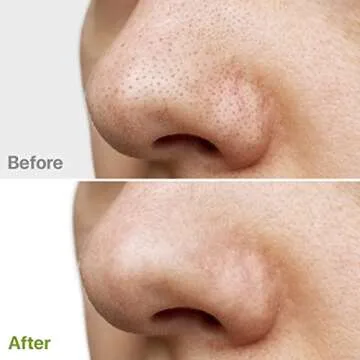 REMEDIAL PAX Glycolic Acid Resurfacing Pads 30% for Face and Body - Exfoliating Facial Peel-Vitamins B5 C E, Green Tea - Glycolic Acid Face Wash – 60 Pre-Moistened Cotton Pads for Cleansing, Peeling