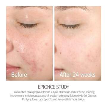 Epionce Purifying Toner for Oily Skin and Breakouts