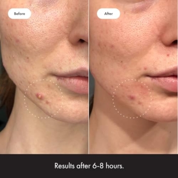 Mighty Patch Hero Invisible+ Acne Patches Ultra Thin Daytime