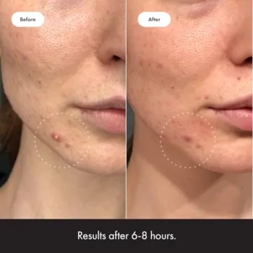 Mighty Patch Hero Invisible+ Acne Patches Ultra Thin Daytime