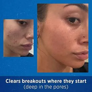 Differin Adapalene Gel 0.1% Acne Treatment, 0.5 Ounces each (Value Pack of 3)