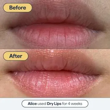 Remedy for Dry Lips - Hydrating Healing Lip Balm Ointment