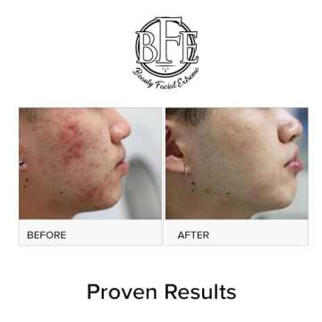 Advanced Acne Treatment Pads - Clear Breakouts Fast!