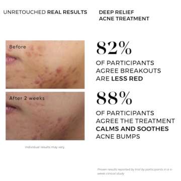 Advanced Acne Treatment Pads - Clear Breakouts Fast!