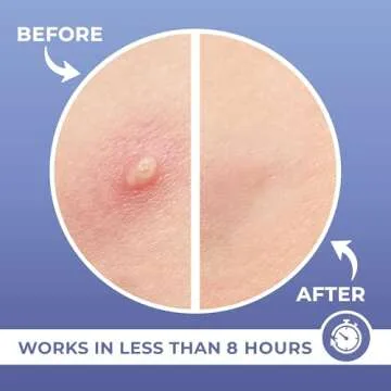 PatchRx Salicylic Pimple Patches - 120 Pack with Tea Tree Oil