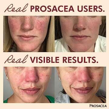 Prosacea - Medicated Rosacea Treatment for Face - Heals Rosacea Symptoms of Redness, Pimples and Irritation - Fragrance Free - Twin Pack - Two 0.75oz Tubes (1.5oz Total)
