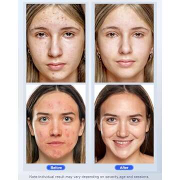 Red Light therapy Mask for Face Wrinkles,Blue Light therapy for Face Acne,Silicone Portable Led Facial Mask Light Therapy for Full Face Even Skin Tone,Fine Lines&Wrinkles,10- Min Treatment,Wired