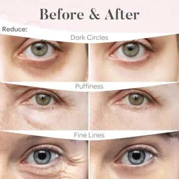 BLOOMORA Rose Under Eye Patches for Dark Circles & Puffiness