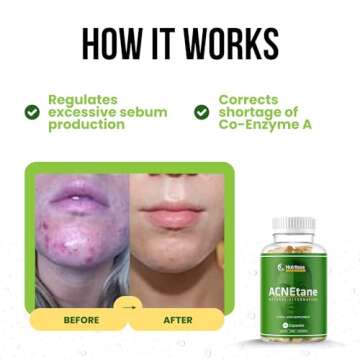 ACNEtane - All Natural Vitamin Supplement for Treating Acne, 90 Veggie Softgels (Treats Hormonal, Puberty, & Cystic Acne Internally)