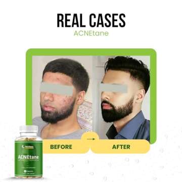 ACNEtane - All Natural Vitamin Supplement for Treating Acne, 90 Veggie Softgels (Treats Hormonal, Puberty, & Cystic Acne Internally)
