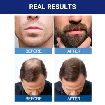 Kirkland Signature Minoxidil 5% Solution Men’s Hair Regrowth