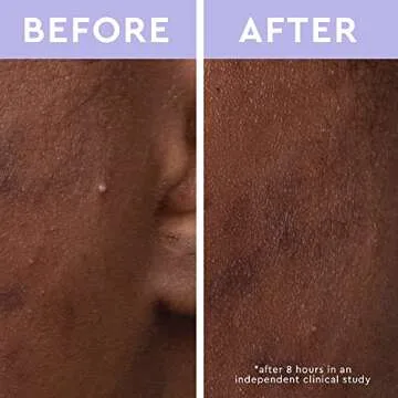 florence by mills Spot A Spot Acne Patches | Remove Dirt + Oil | Salicylic Acid + Hydrocolloid | Peppermint Oil + Tea Tree Oil | Vegan & Cruelty-Free - 36 stickers…