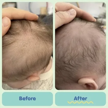 Top Cradle Cap Care Bundle from Tubby Todd for Babies