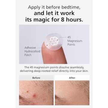 EasyDerm Quick Calming Magnesium Patches – Hydrocolloid Acne Spot Treatment with Tea Tree & Cica, 10 Patches, Zit Sticker, TikTok Viral Blemish Patch