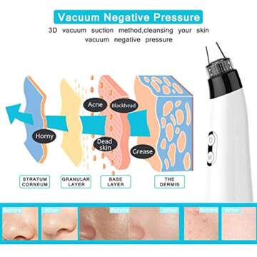 Blackhead Remover Vacuum Pore Cleaner - Acne Comedone Extractor Whitehead Tool Exfoliating Machine Removal Beauty IPL with 5 Adjustable Suction Power and 5 Replacement Probes LED USB Rechargeable