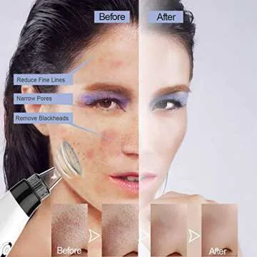 Premium Blackhead Remover Vacuum with IPL Therapy and USB Recharge