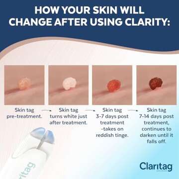 FDA-Cleared Skin Tag Removal Device – Claritag