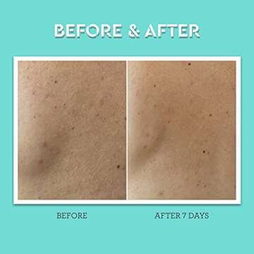 Bliss Clear Genius Body Acne Spray - 3.5 Fl Oz - Maximum Strength 2% Salicylic Acid & Niacinamide - Targets Body Acne & Prevents Future Breakouts - Post Workout - Clean - Vegan & Cruelty-Free